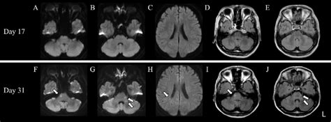 Figure Brain Mri On Day And On Day A C Diffusion Weighted