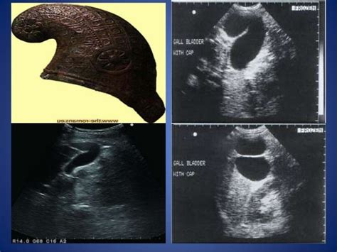 Gall Bladder And Biliary Tract Anomalies And Variants