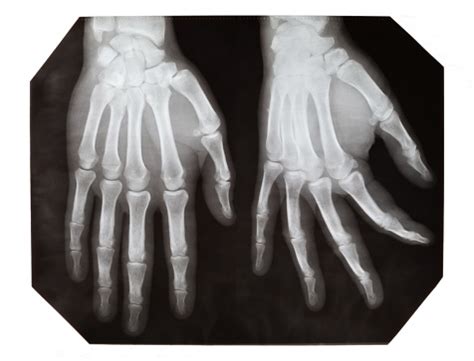 Xray Images Of A Hand With A Fracture On A White Stock Photo - Download ...