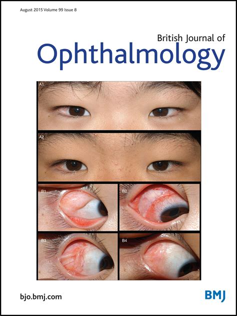 Ziv Aflibercept In Macular Disease British Journal Of Ophthalmology