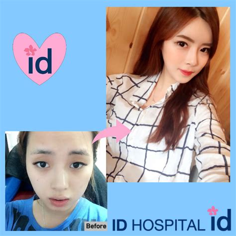 Id Hospital Korea Korea Plastic Surgery Before And After Double