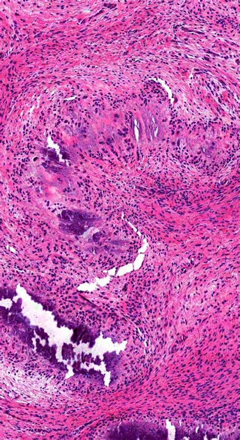 Pathology Of Calcifying Aponeurotic Fibroma Pathology Infographic