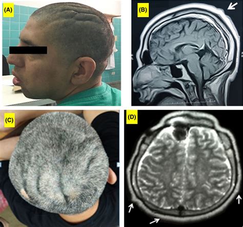 Cutis Verticis Gyrata Two Cases Associated With Drug‐resistant