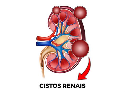 Cisto no Rim é Perigoso Pode virar câncer Dr Eduardo Costa