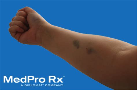 Infused But Bruised How To Cover Hemophilia Bruises Medpro Rxmedpro Rx