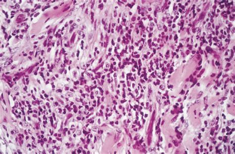 A Dermal Infiltrate Of Atypical Lymphocytes With Cerebriform Nuclei Is