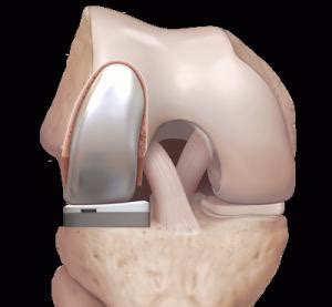 Protesi Monocompartimentale Di Ginocchio Ometti Ortopedico