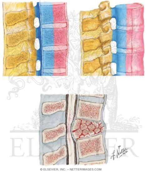 Three Column Concept Of Spinal Stability