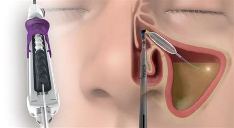 Balloon Sinuplasty — Clmc Ent