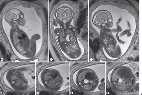 Congenital Diaphragmatic Hernia Mri