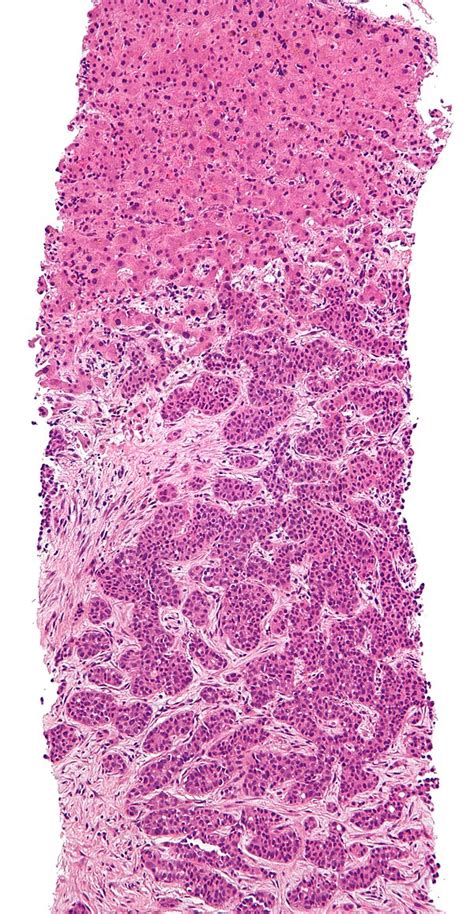 Liver Metastasis Libre Pathology