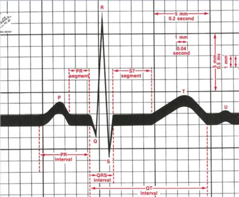 EKG FINAL PICTURES ONLY Flashcards Quizlet