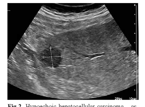 Figure 1 from Ultrasound screening for hepatocellular carcinoma in ...