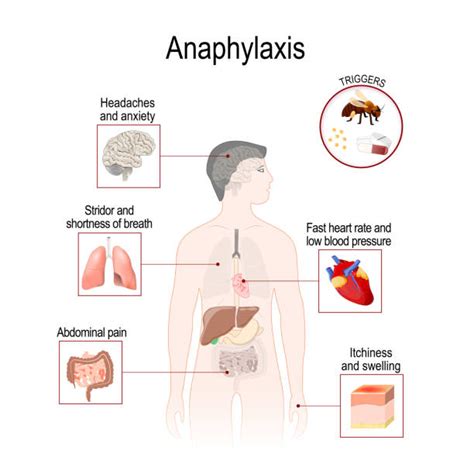 Anaphylactic Shock Illustrations, Royalty-Free Vector Graphics & Clip ...