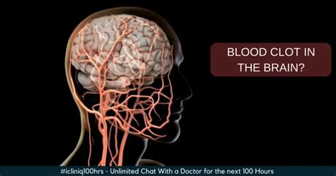 The MRI of the brain shows a blood clot. Please help.