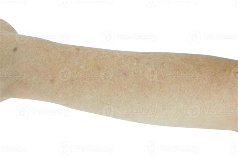 Hypomelanosis