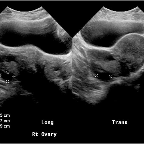 Preoperative Mri Pelvis Right Fibroid Download Scientific Diagram