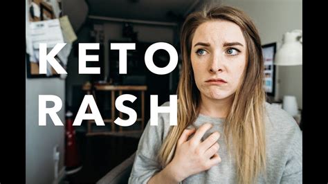 I Cured My Keto Rash My Experience With Keto Rash And How I Found