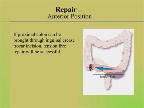 Laparoscopic Sigmoid Colon Resection Supine And Lateral