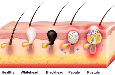 Exeter Acne Diagnosis And Treatments