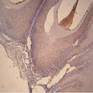 Matrix Metalloproteinase Expression In Oral Squamous Cell Carcinoma