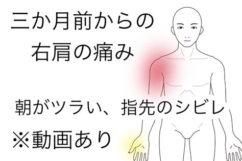 3ヶ月前からの右肩の痛み しらお鍼灸院