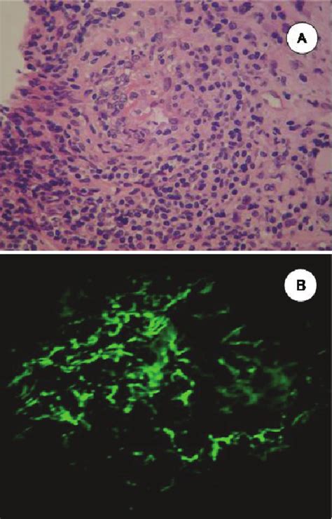 A Arteritis With Fibrinoid Necrosis In A Case Of Acute Pancreas Download Scientific Diagram