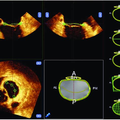 3 Dimensional Echocardiographic Assessment Of Mitral Annulus And