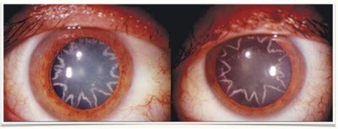 thermal  electrical ocular injuries flashcards quizlet