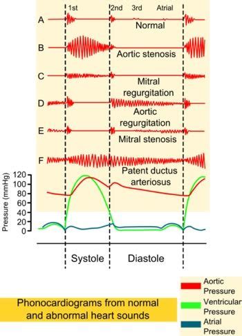 Heart Murmurs. #cardiology Enlarge: pinterest.com/pin ...