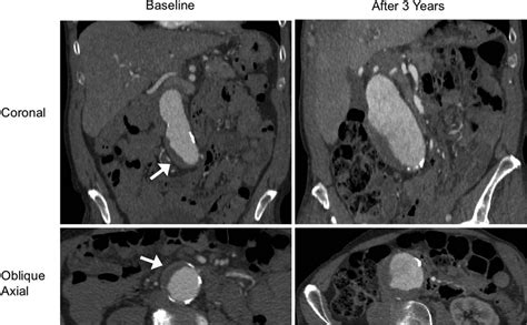 Presence of blood clot associated with rapid aortic aneurysm growth ...