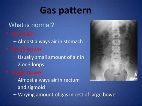 Abdomen Xray Signs