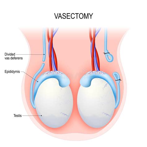 Vasectomy Open Ended Method And Ligating Suturing Stock Vector Illustration Of Ligating