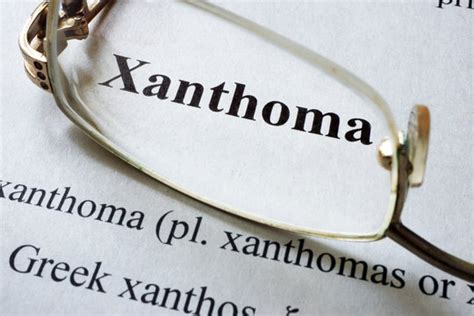 Xanthoma Images – Browse 42 Stock Photos, Vectors, and Video | Adobe Stock