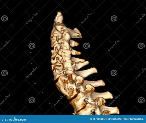 Cervical Fracture And Human Spine And Vertebrae Damage Outline Diagram