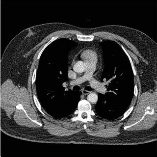 a: MRI pituitary gland. Figure shows a coronal post contrast T1 ...