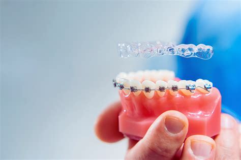 The Benefits Of Orthodontic Treatment Beyond Aesthetics Royal Dental Care