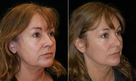 Mini Facelift On Middle Aged Female Patient Aesthetica Cosmetic Surgery And Laser Center