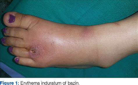 Erythema Induratum