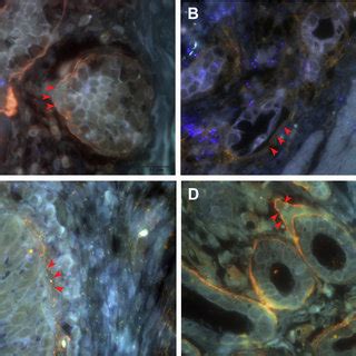 Morphological Changes Of Collagen Iv In Tumor Tissues Based On Qds