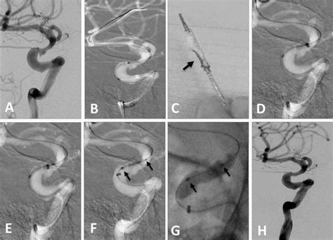 single center experience   endovascular treatment  carotid