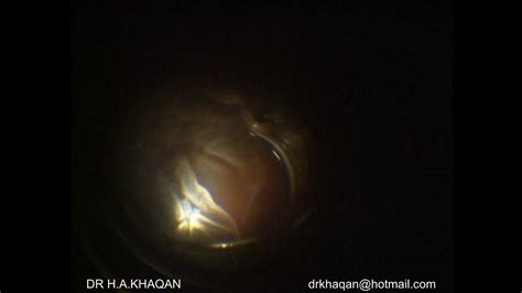 Vitrectomy For Giant Retinal Tear With PVR Nucleus Drop By Dr Hussain