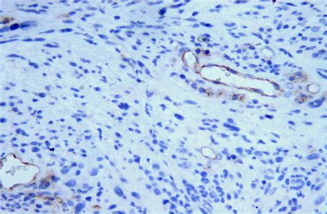 Kaposis Sarcoma Ihc Staining For Cd31 Positive Ob 20× Download