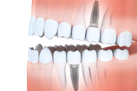 Dental Implants Rockwall Sulphur Springs Pinnacle Oms