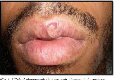 Figure 1 From Solitary Keratoacanthoma Involving Upper Lip A