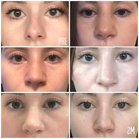 List 105 Pictures Rhinoplasty Recovery Photos Day By Day Updated