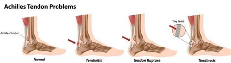 Suffering From Achilles Tendinopathy Put Your Feet In Our Hands