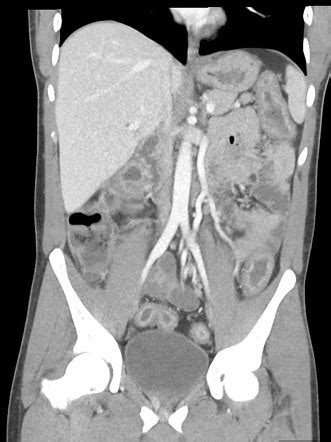 Ulcerative Colitis Image Radiopaedia Org