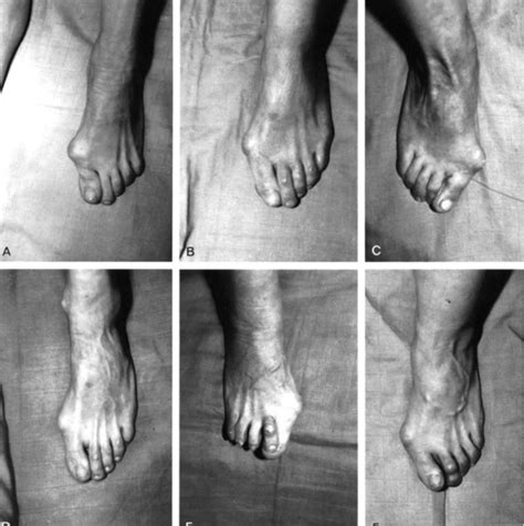 Big toe pain: Causes, Symptoms, Diagnosis, Treatment & Surgery | ALGCURE