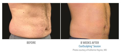 Coolsculpting Stomach Fat Before And After Photos